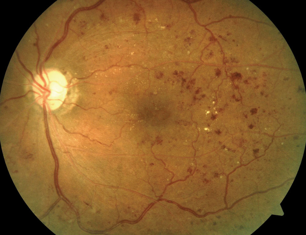 Image of eye with diabetic retinopathy