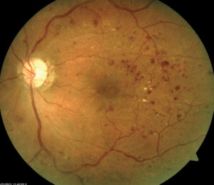 Image of eye with diabetic retinopathy